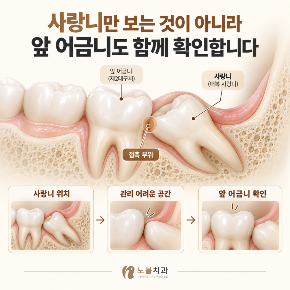 사랑니의 위치가 주변 치아에 영향을 줄 수 있습니다.