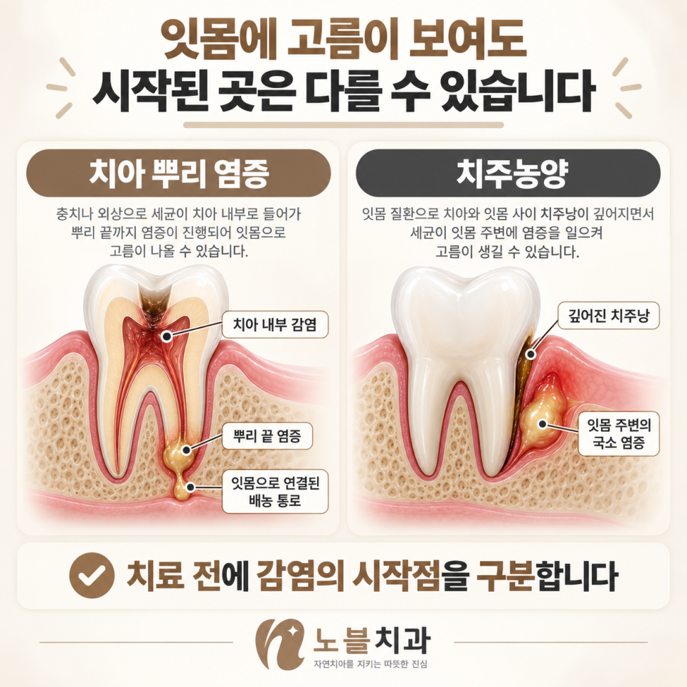 치료 전에 감염의 시작점을 구분합니다.