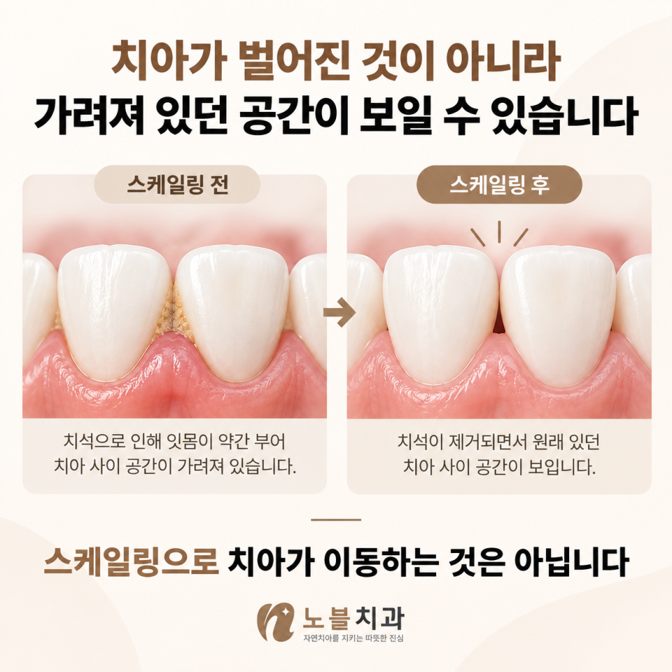 스케일링으로 치아가 이동하는 것은 아닙니다.