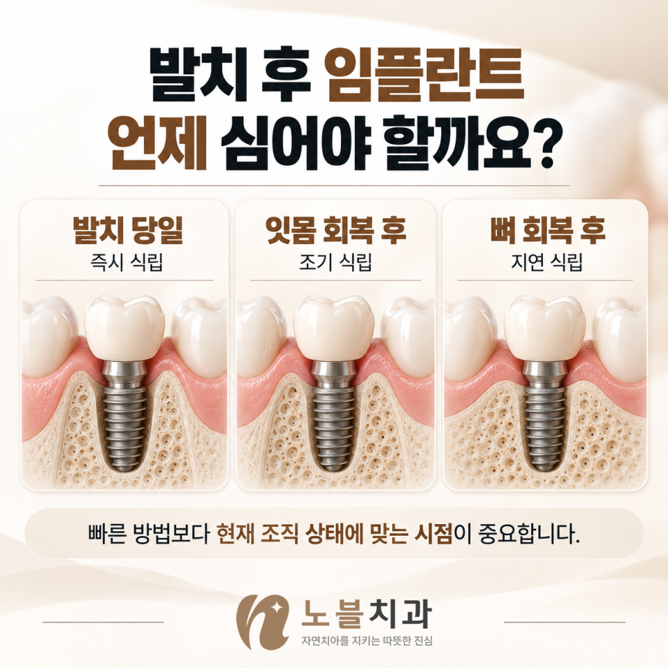 중요한 것은 이식 여부 보다 왜 필요한지를 확인하는 것입니다.