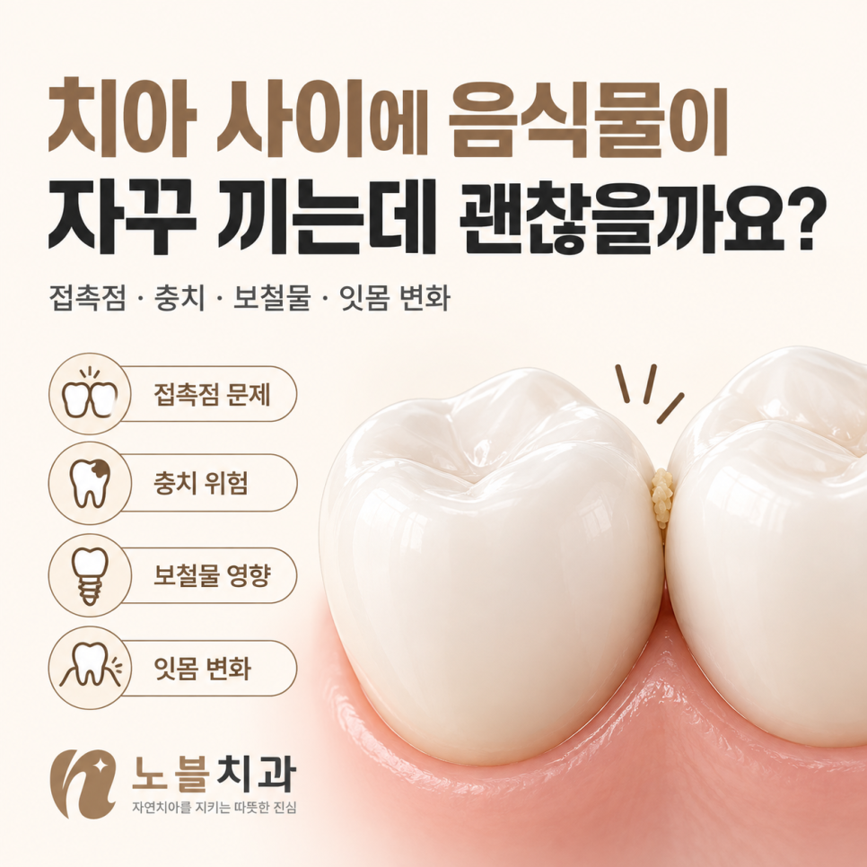 접촉점 · 충치 · 보철물 · 잇몸 변화 원인에 따라 관리 방법도 달라집니다.