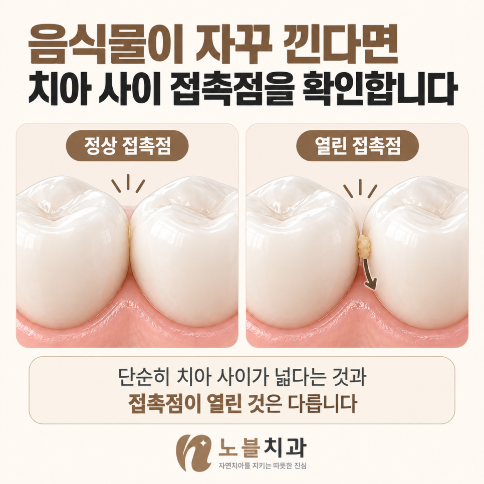 단순히 치아 사이가 넓다는 것과 접촉점이 열린 것은 다릅니다.