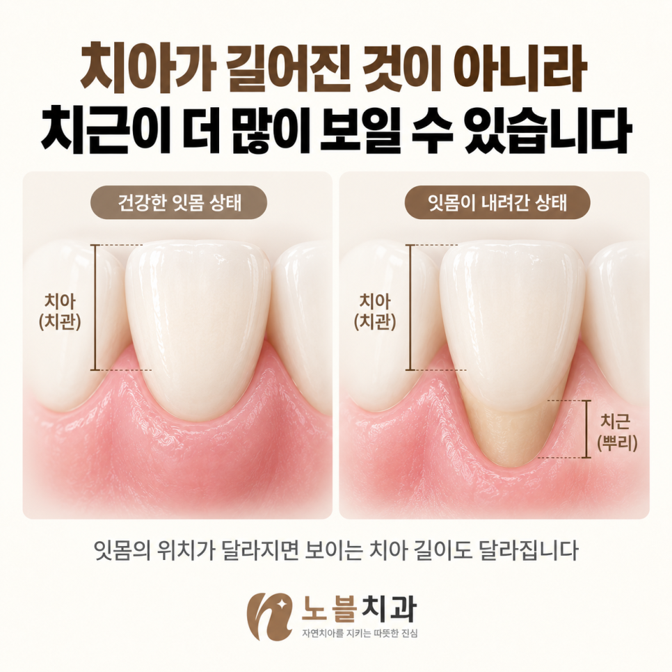 잇몸의 위치가 달라지면 보이는 치아 길이도 달라집니다.