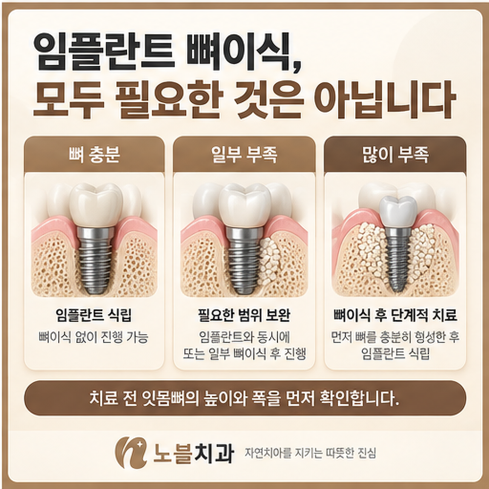 수원 장안구치과 임플란트 뼈이식은 꼭 필요한가요?