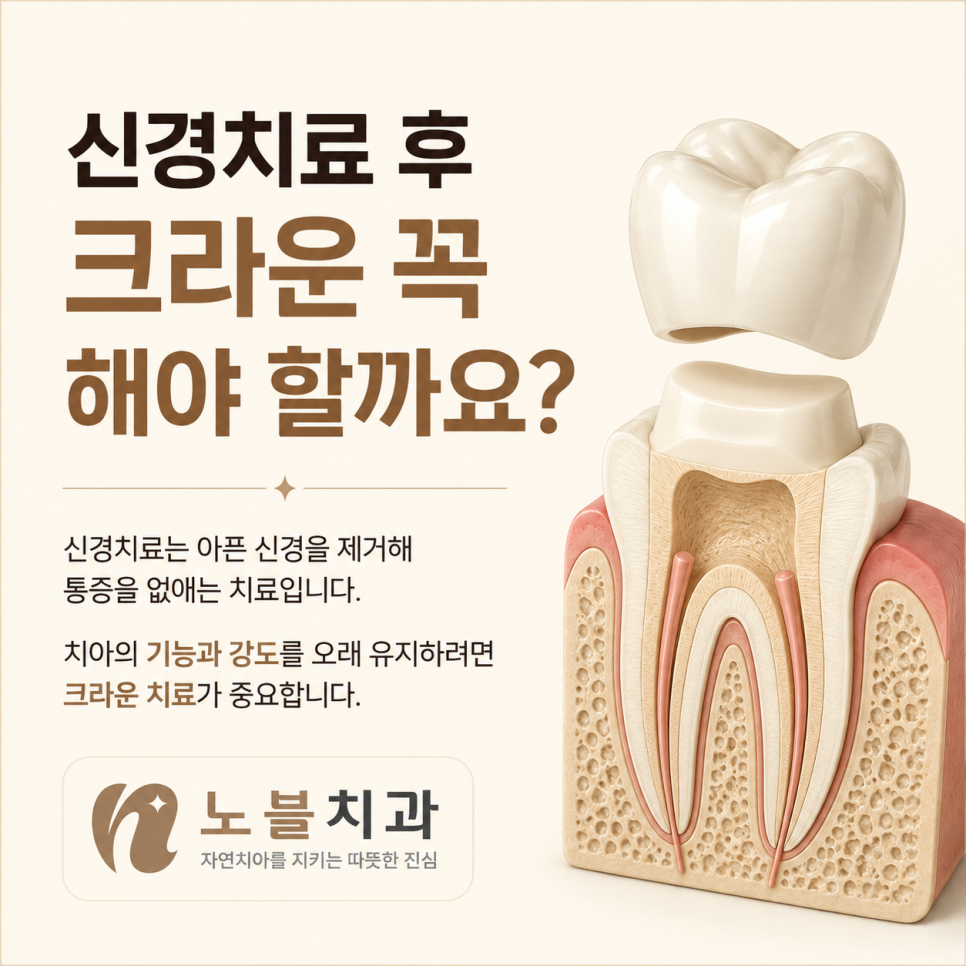 수원 정자동 치과 신경치료 후 크라운, 꼭 씌워야 할까요?