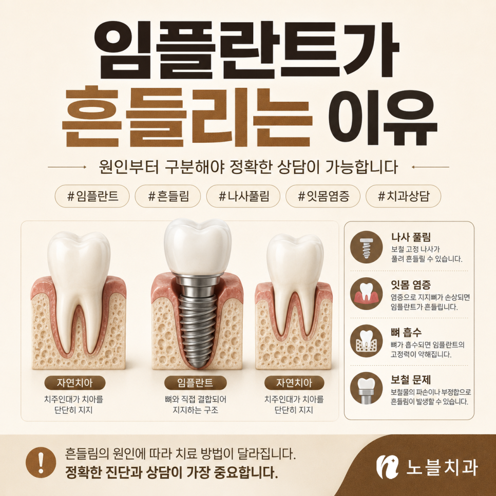 수원 치과 추천 기준, 임플란트가 흔들릴 때 확인해야 할 원인