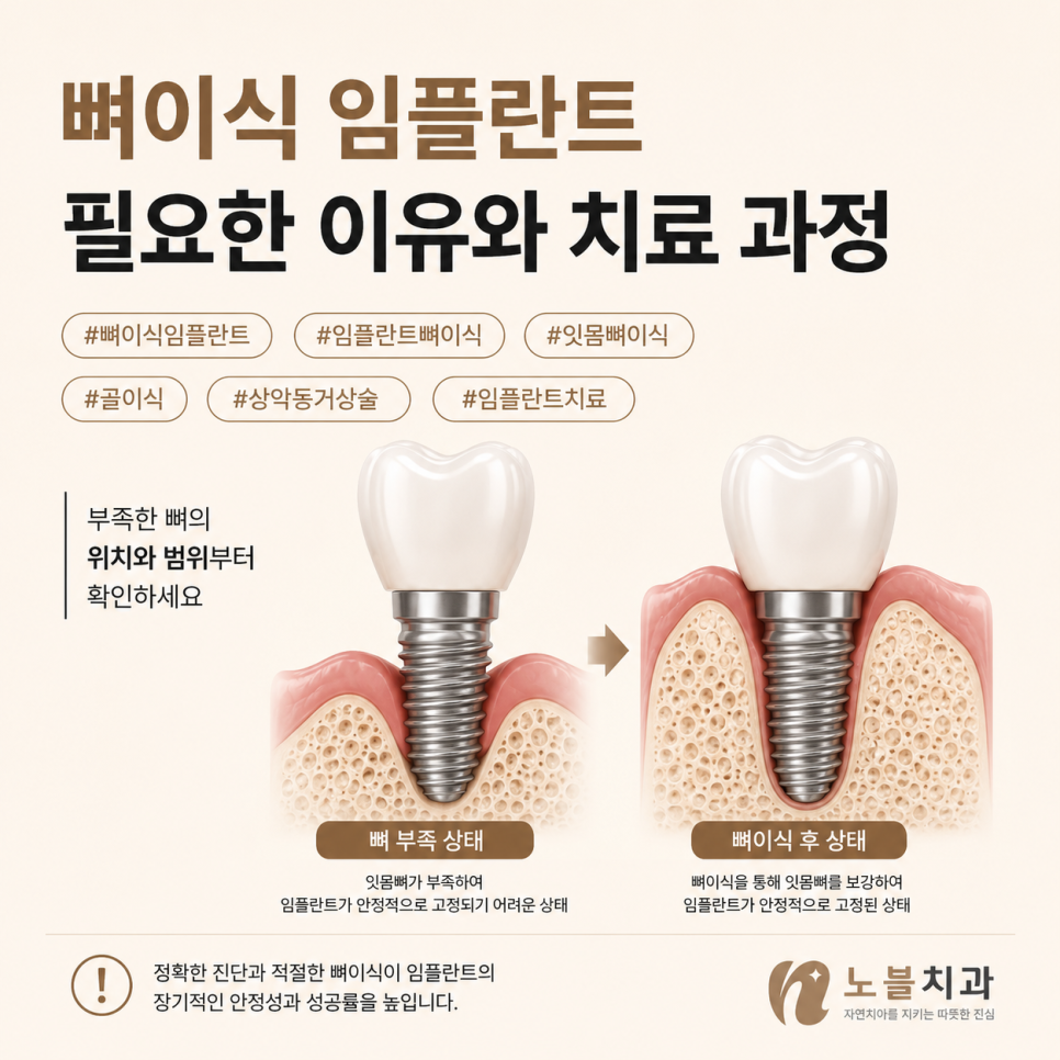 수원치과 뼈이식 임플란트는 언제 필요할까? 검사부터 회복까지