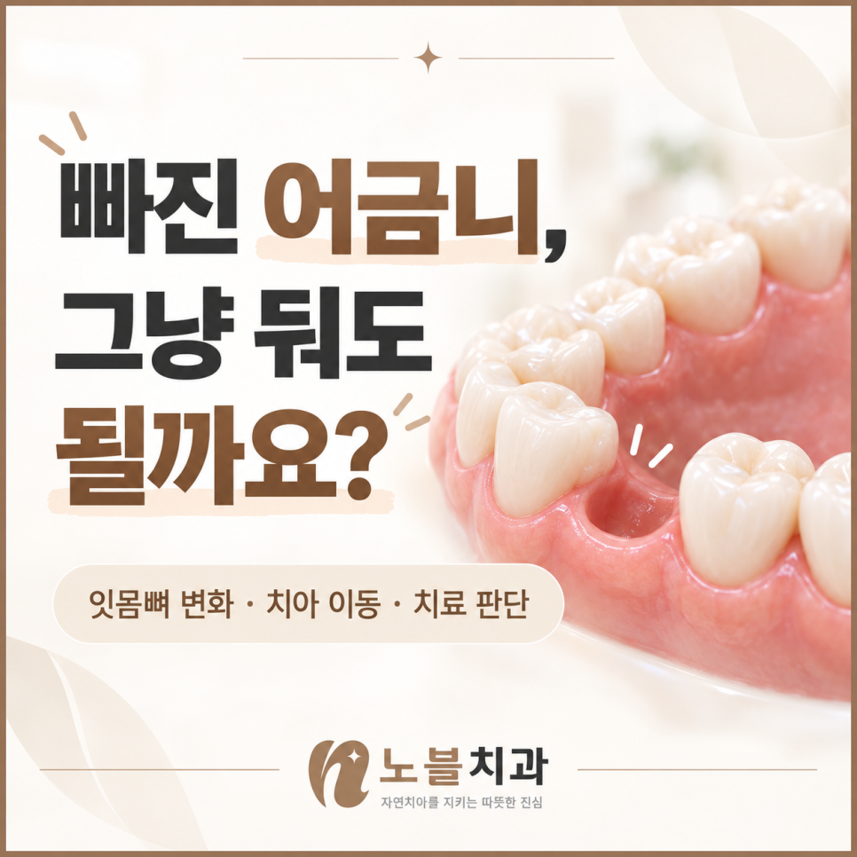 수원임플란트치과 빠진 어금니를 오래 방치하면 생기는 변화