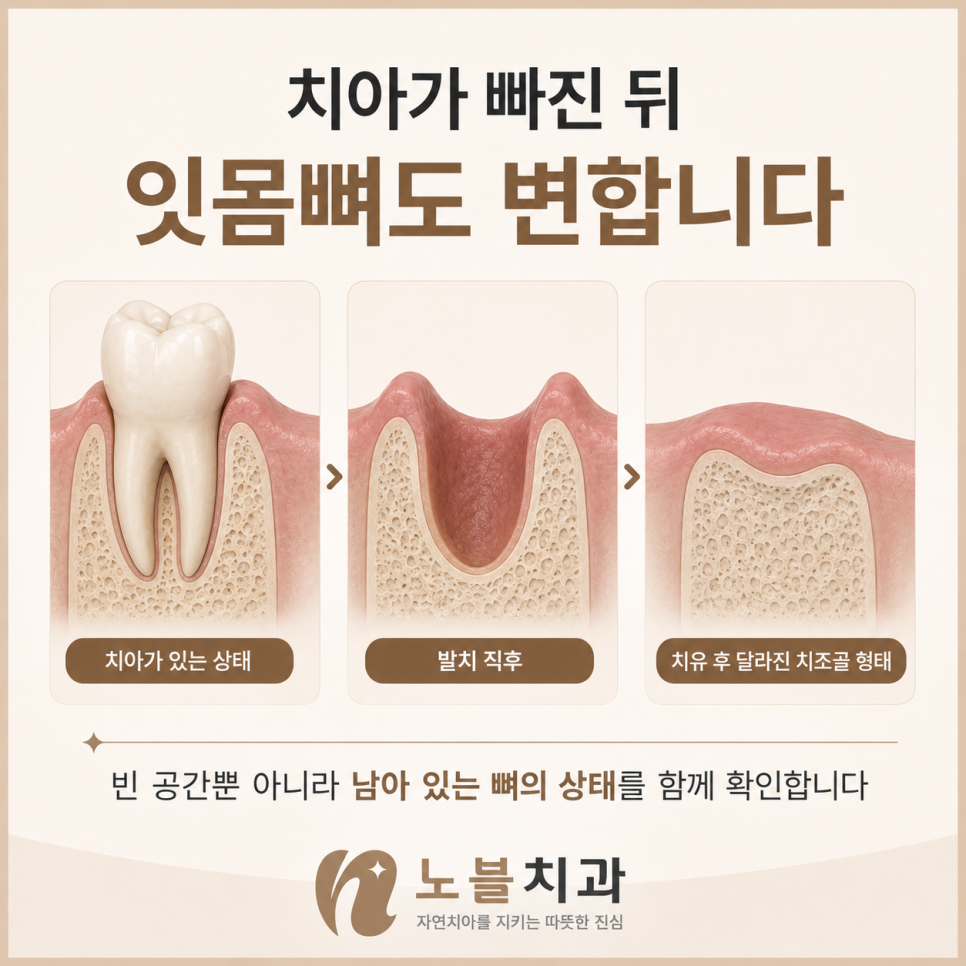 빈 공간만 보는 것이 아니라 임플란트를 지지할 뼈의 상태를 함께 확인합니다.