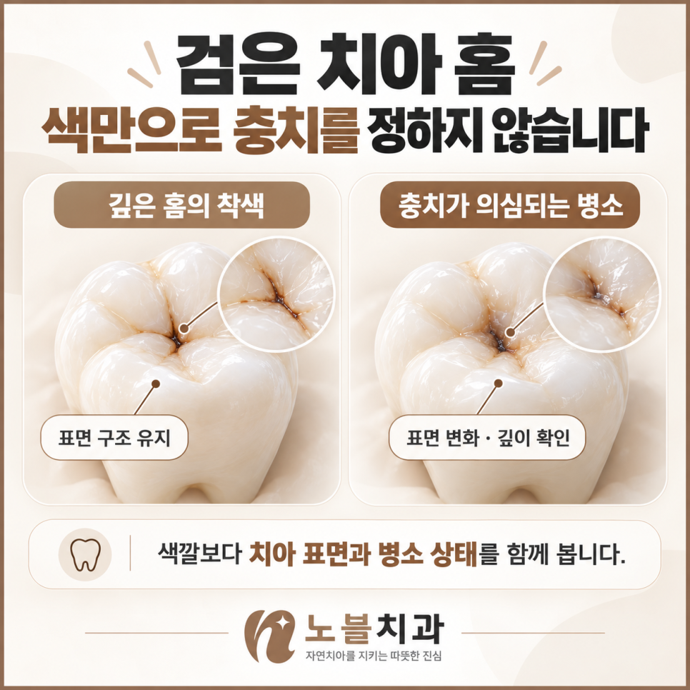 색깔보다 치아 표면과 병소 상태를 함께 봅니다.