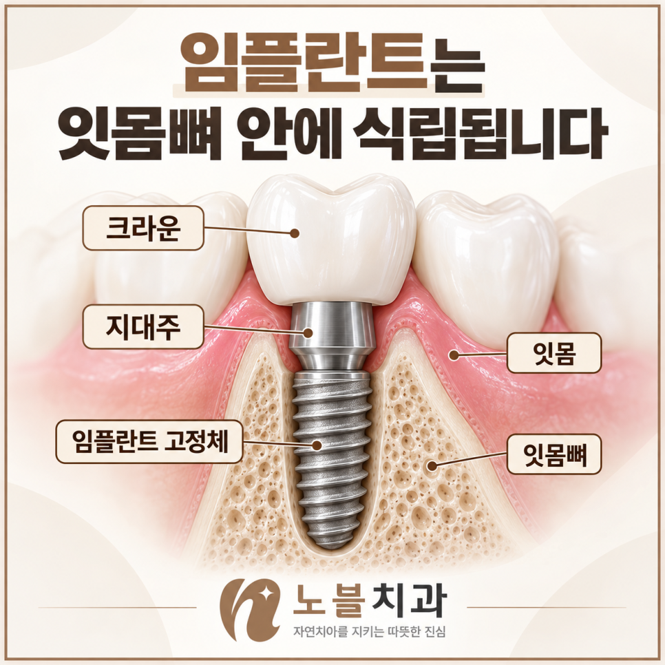 수원 장안구치과 임플란트 뼈이식은 꼭 필요한가요?