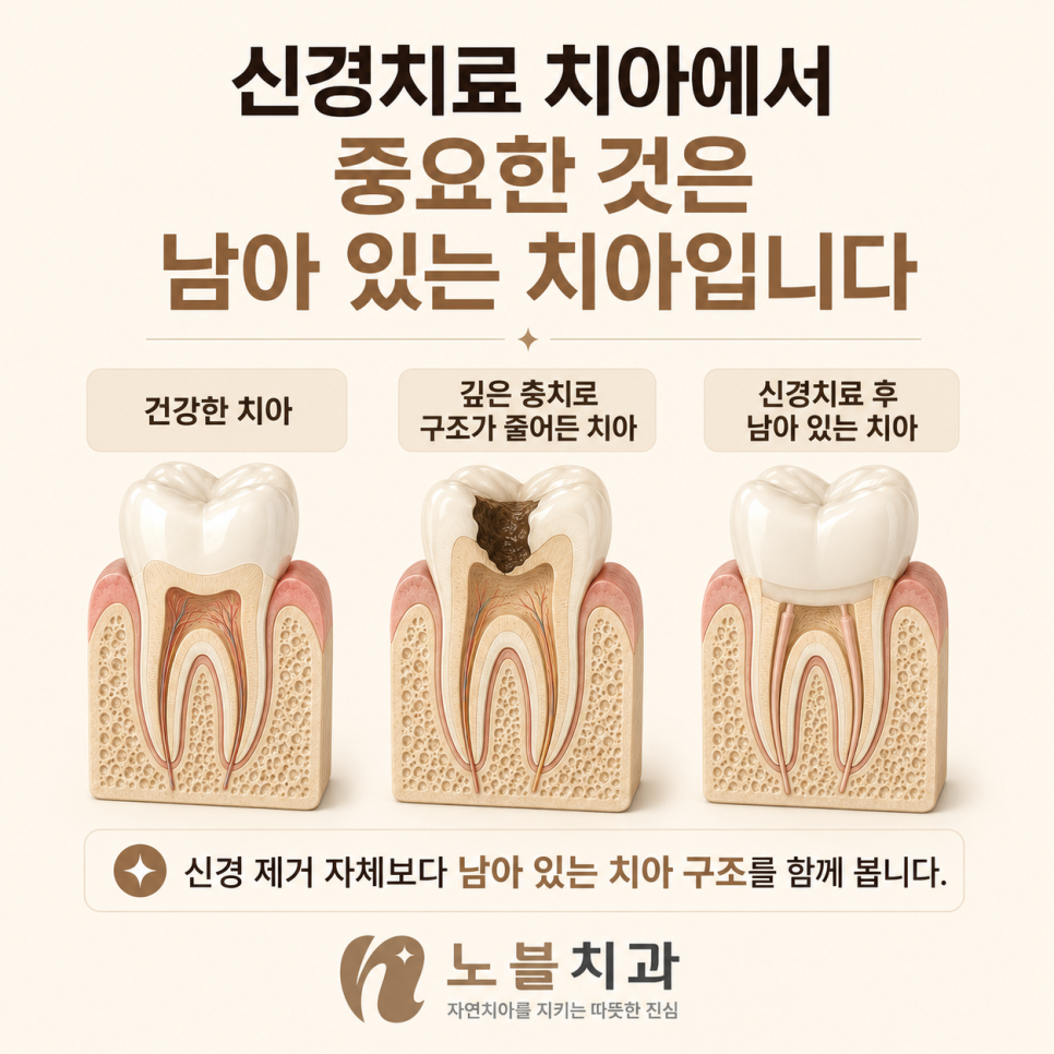 신경 제거 자체보다 충치·파절·기존 수복으로 줄어든 치아 구조를 함께 봅니다.