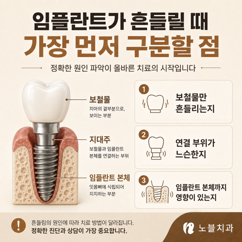 수원 치과 추천 기준, 임플란트가 흔들릴 때 확인해야 할 원인