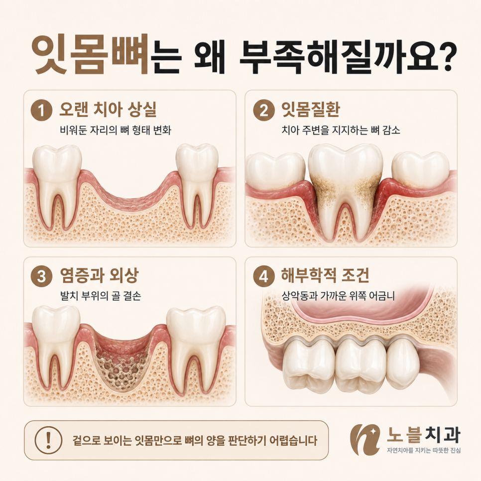 수원치과 뼈이식 임플란트는 언제 필요할까? 검사부터 회복까지