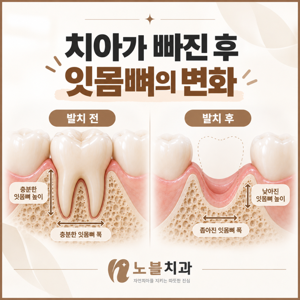 수원임플란트치과 빠진 어금니를 오래 방치하면 생기는 변화