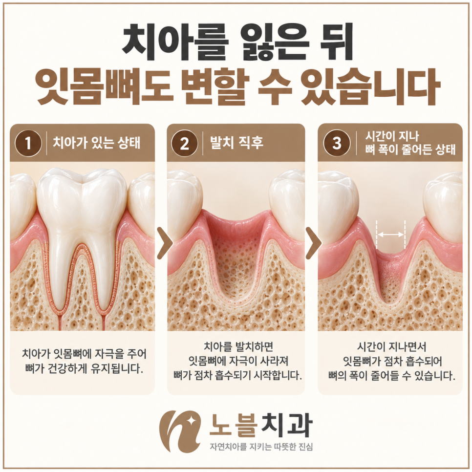 수원 장안구치과 임플란트 뼈이식은 꼭 필요한가요?