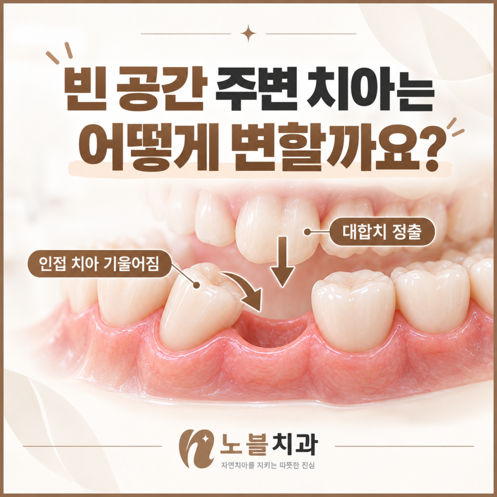 수원임플란트치과 빠진 어금니를 오래 방치하면 생기는 변화