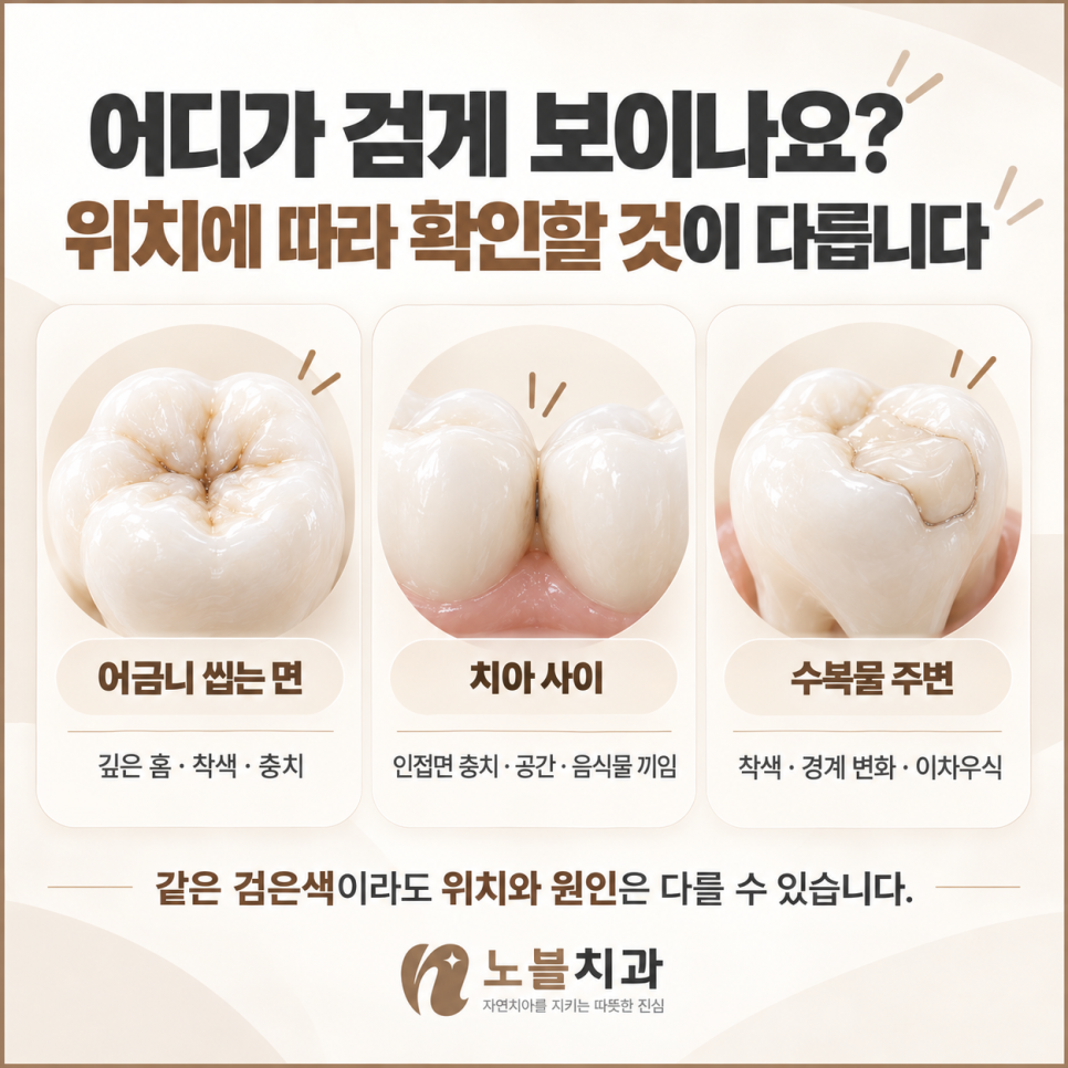 같은 검은색이라도 위치와 원인은 다를 수 있습니다.