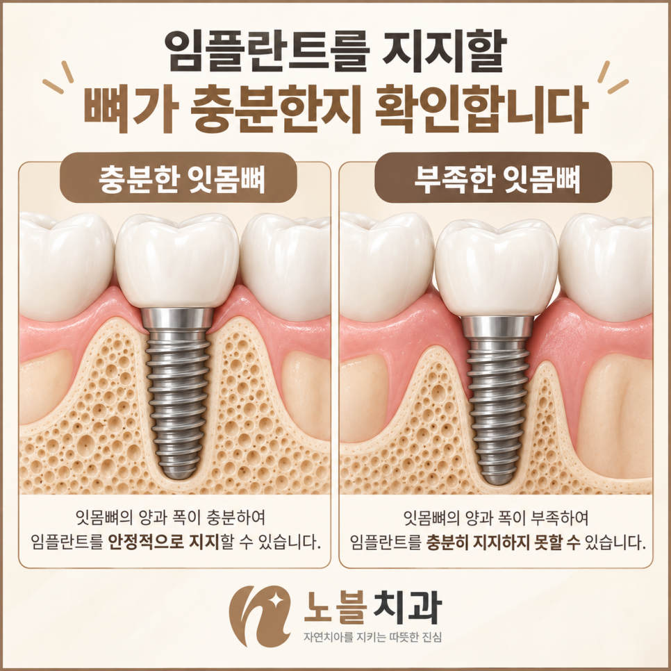 수원 장안구치과 임플란트 뼈이식은 꼭 필요한가요?