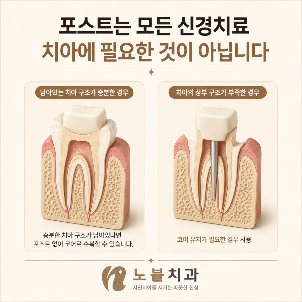 포스트는 모든 신경치료 치아에 필요한 과정이 아닙니다.