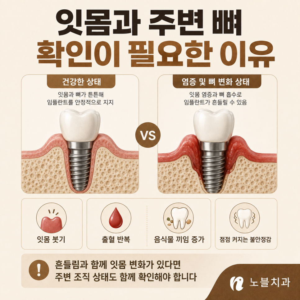 수원 치과 추천 기준, 임플란트가 흔들릴 때 확인해야 할 원인