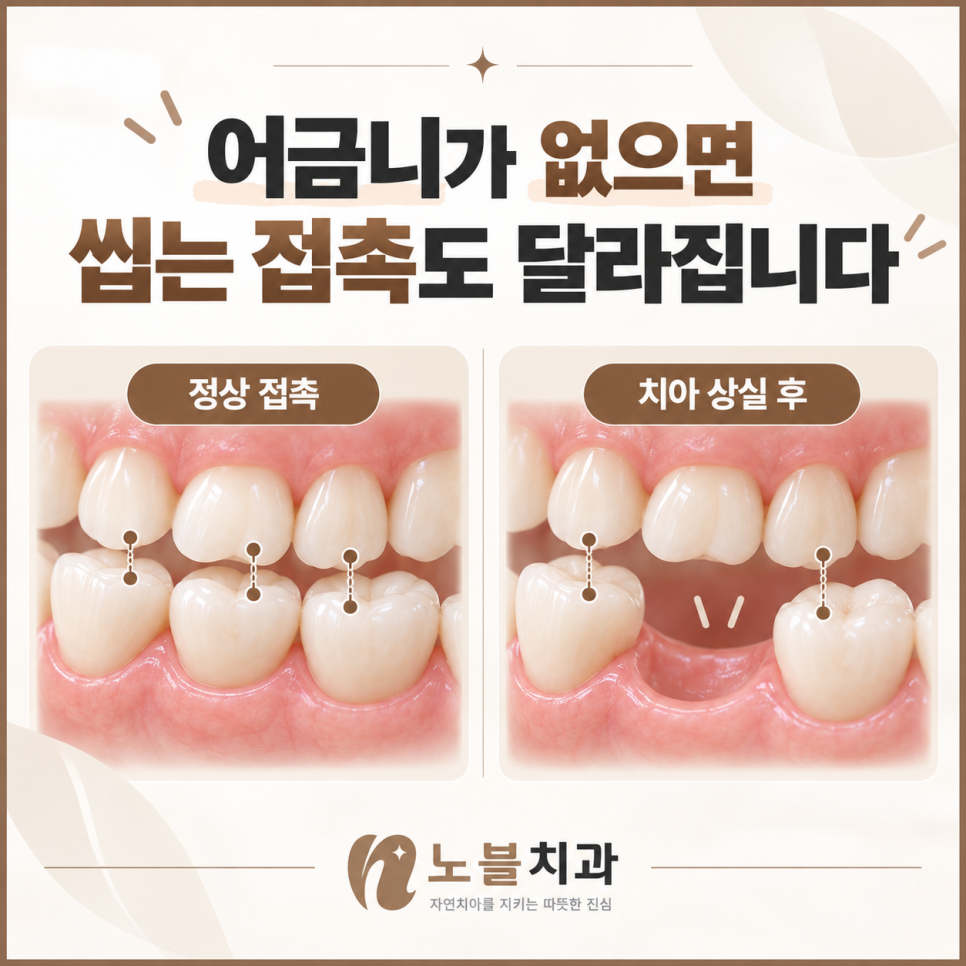 수원임플란트치과 빠진 어금니를 오래 방치하면 생기는 변화