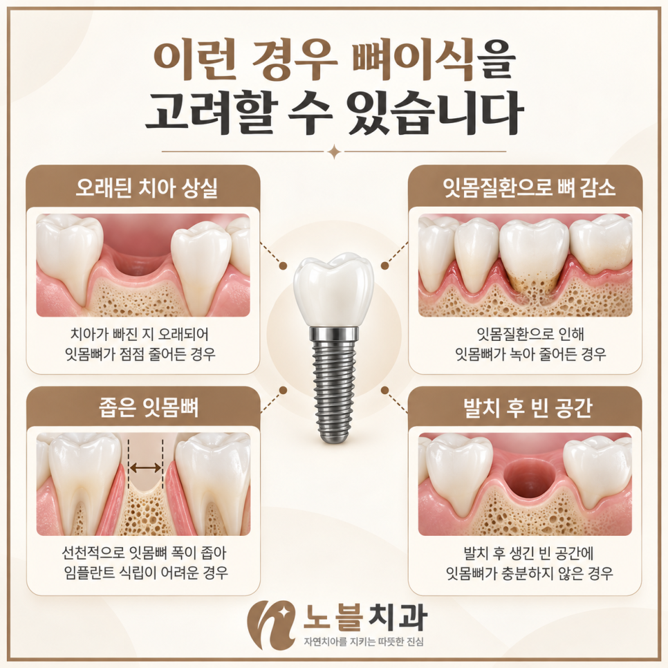 수원 장안구치과 임플란트 뼈이식은 꼭 필요한가요?