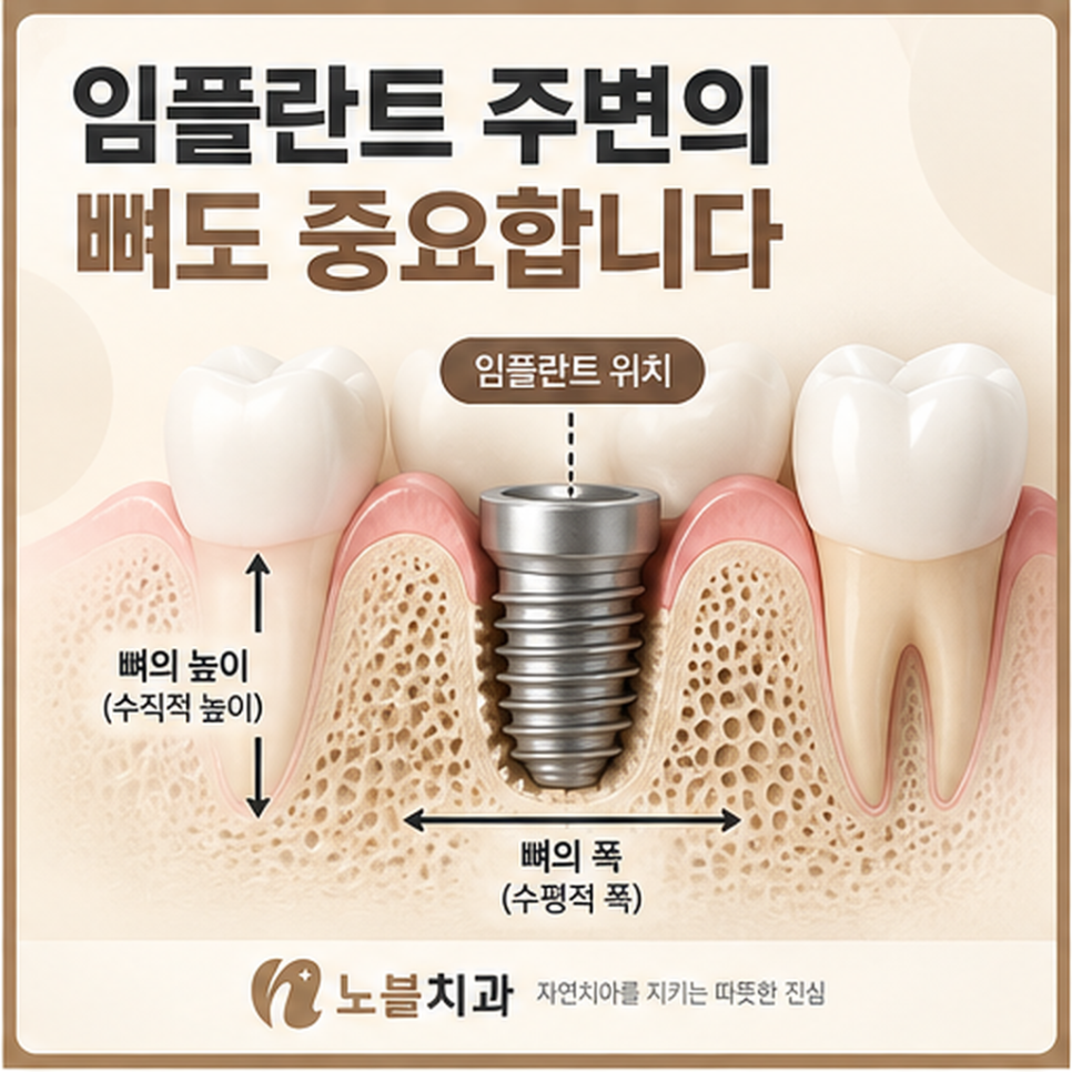 수원 장안구치과 임플란트 뼈이식은 꼭 필요한가요?