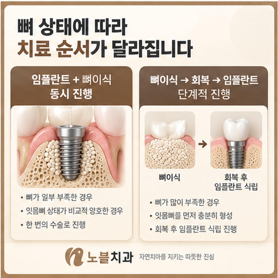 수원 장안구치과 임플란트 뼈이식은 꼭 필요한가요?