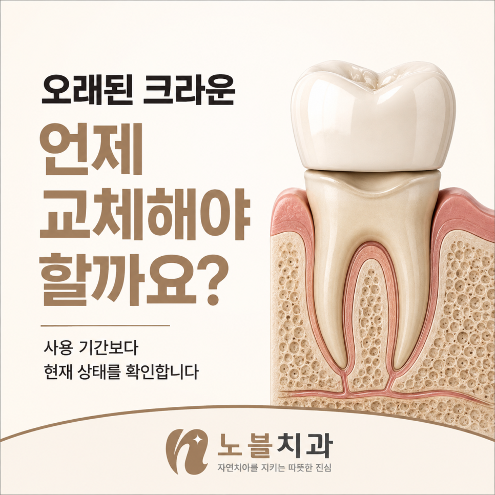 화서역 치과 오래된 크라운, 언제 교체해야 할까요?