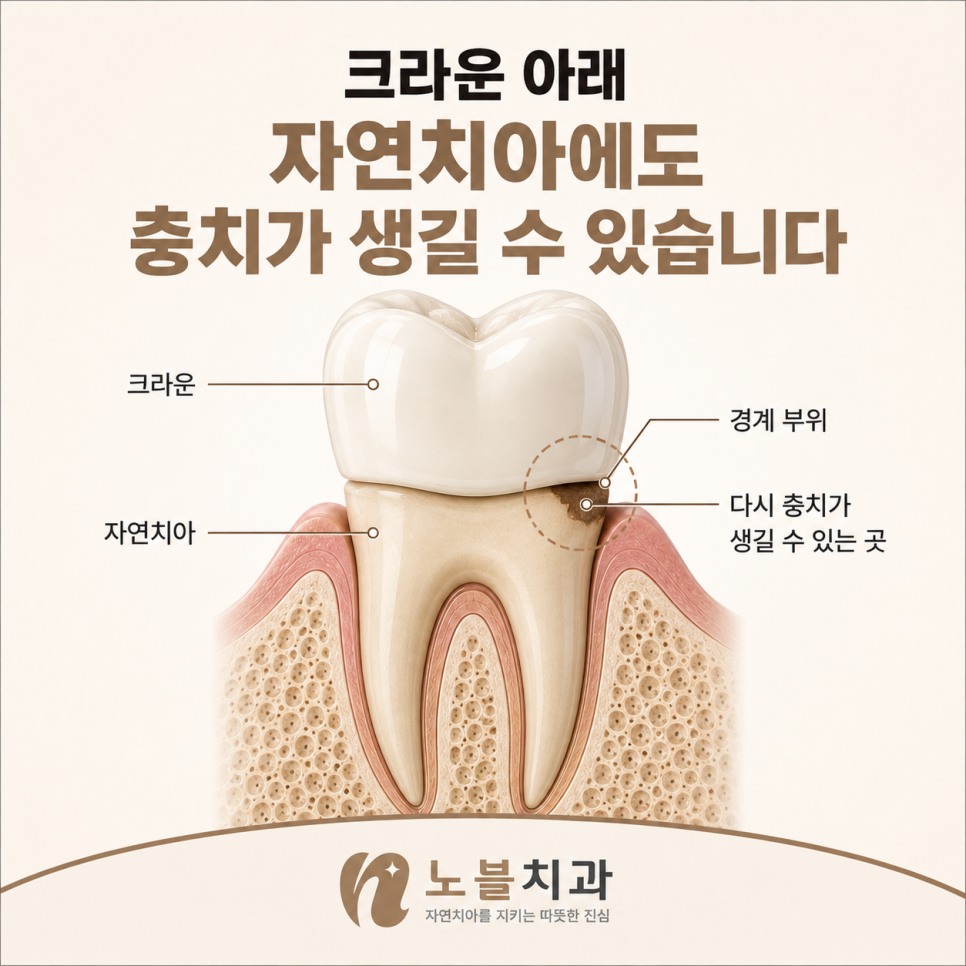 같은 기간 사용했어도 치아 상태는 다를 수 있습니다.