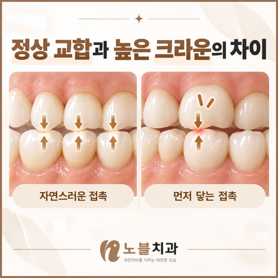 수원치과, 새로 씌운 크라운이 높게 느껴진다면 적응해야 할까요?
