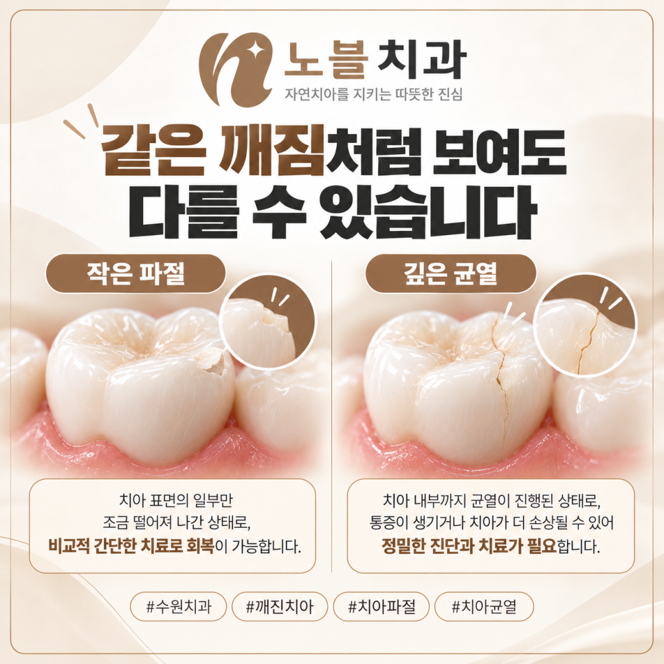 수원치과에서 치아가 깨졌을 때, 레진과 크라운은 어떻게 다를까요?