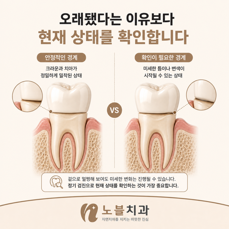 크라운이 아니라 그 아래 자연치아를 함께 봅니다.