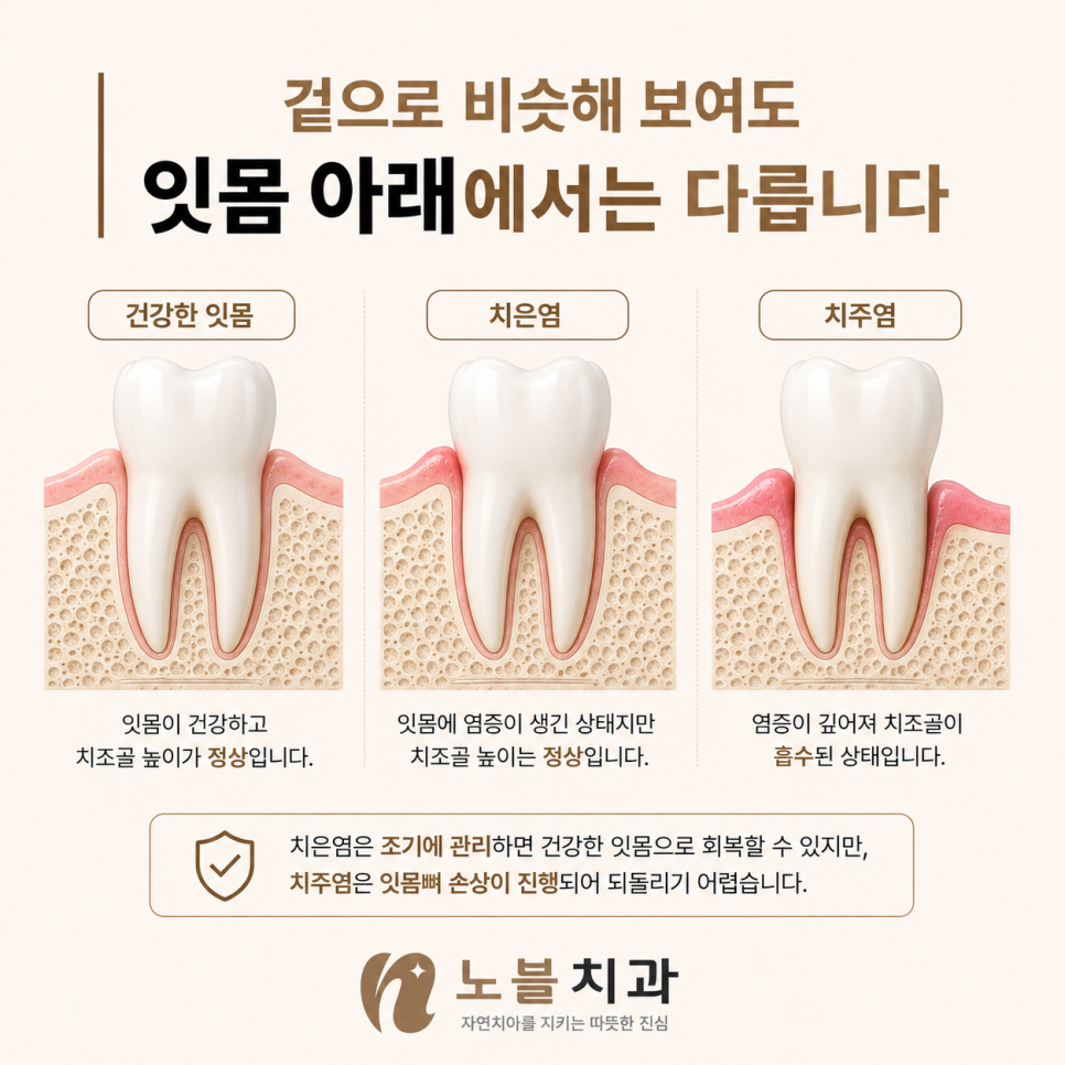 피가 나는지만이 아니라 치아를 지지하는 조직을 확인합니다.