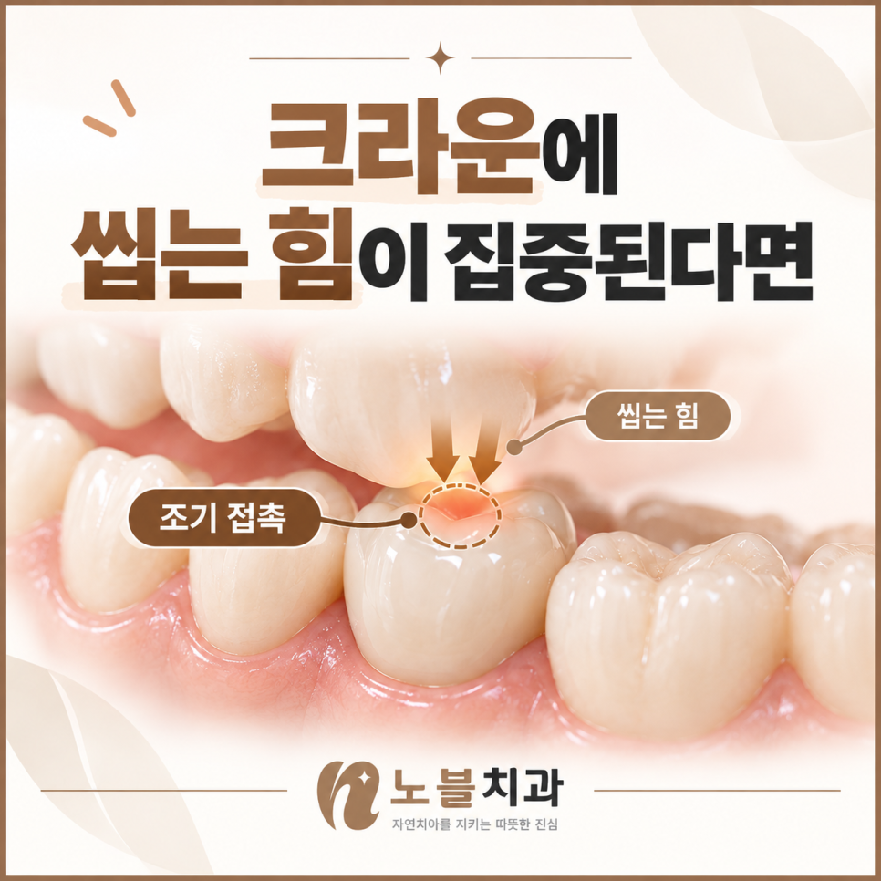 수원치과, 새로 씌운 크라운이 높게 느껴진다면 적응해야 할까요?
