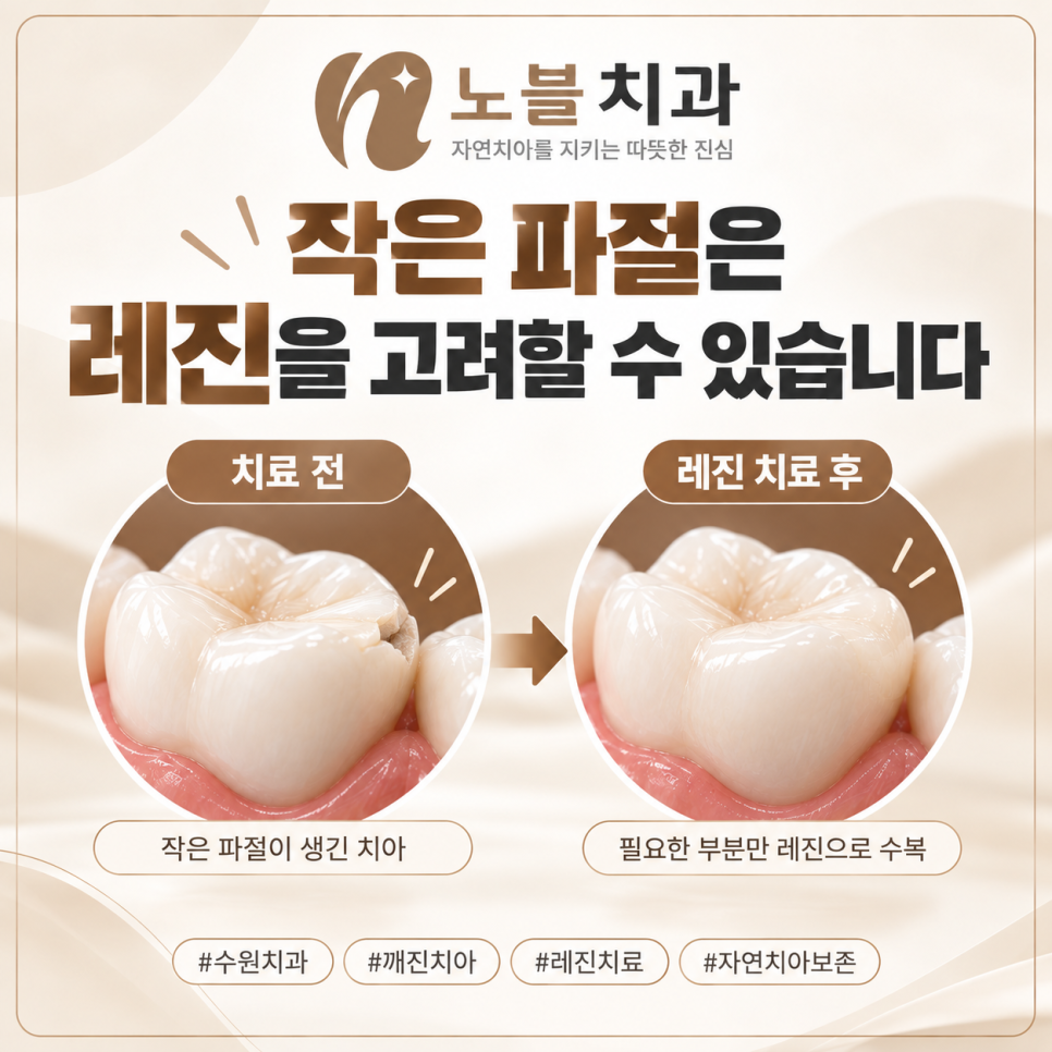 수원치과에서 치아가 깨졌을 때, 레진과 크라운은 어떻게 다를까요?