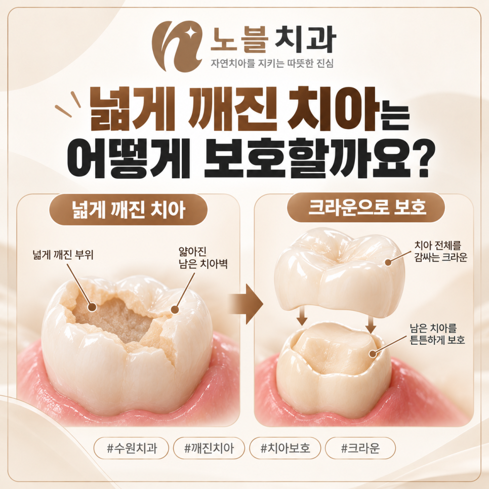 수원치과에서 치아가 깨졌을 때, 레진과 크라운은 어떻게 다를까요?