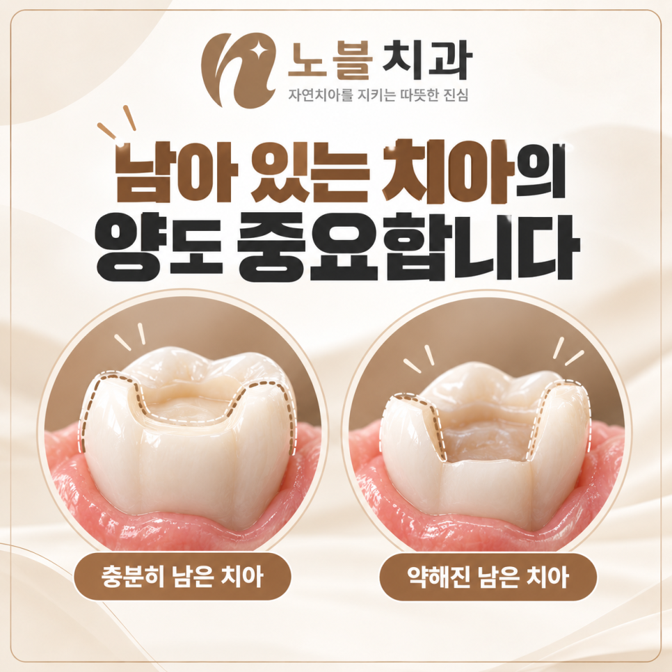 수원치과에서 치아가 깨졌을 때, 레진과 크라운은 어떻게 다를까요?