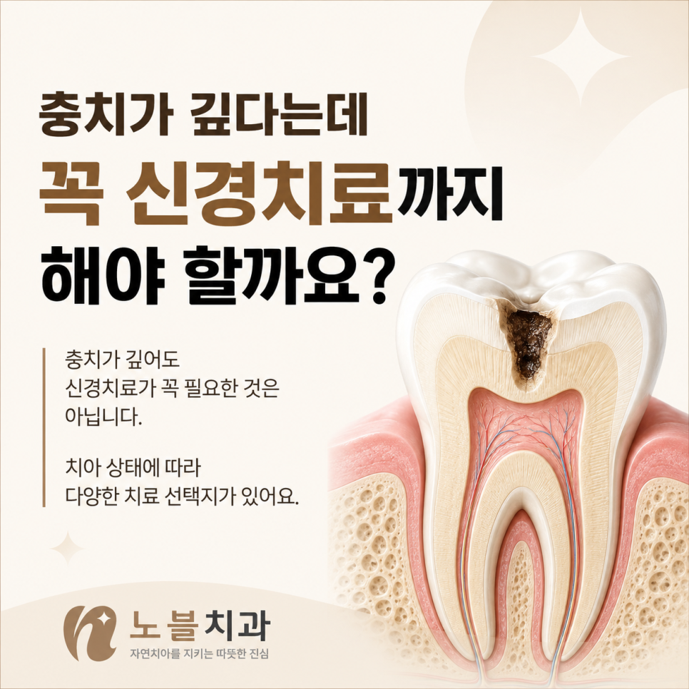 수원 천천동 치과 충치가 깊다는데, 꼭 신경치료까지 해야 할까요?