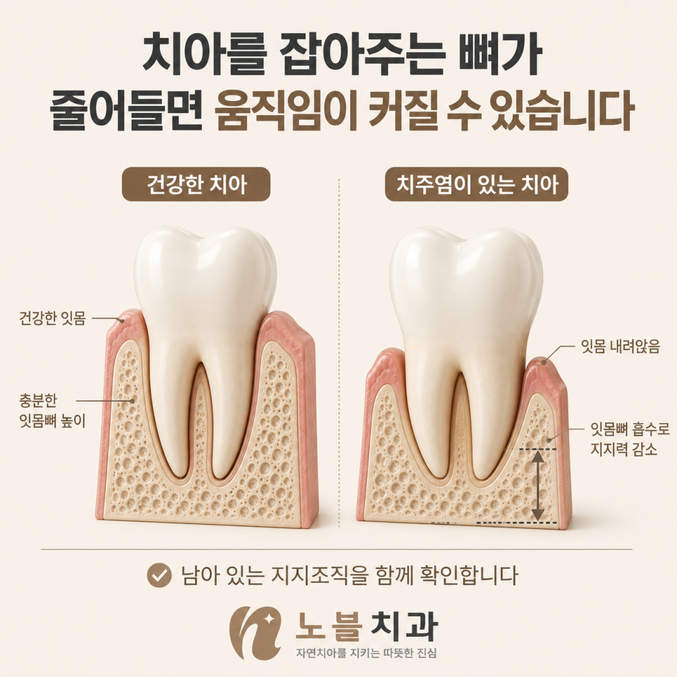 흔들림의 정도보다 남아 있는 지지조직을 함께 확인합니다.