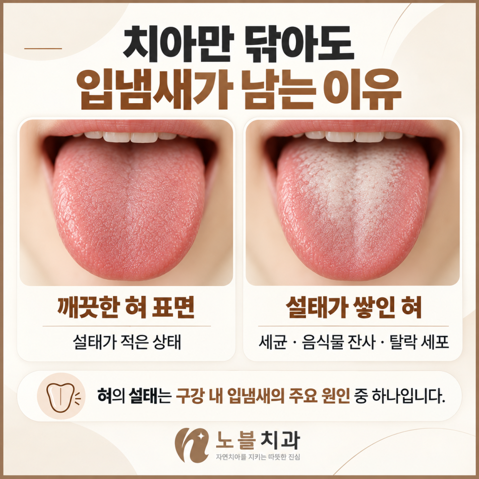 혀의 설태는 구강 내 입냄새의 주요 원인 중 하나입니다.