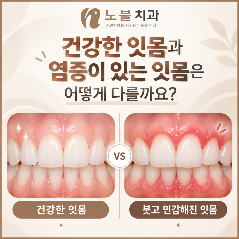 수원치과에서 잇몸이 자꾸 붓고 피가 나면 스케일링만 받아도 될까요?