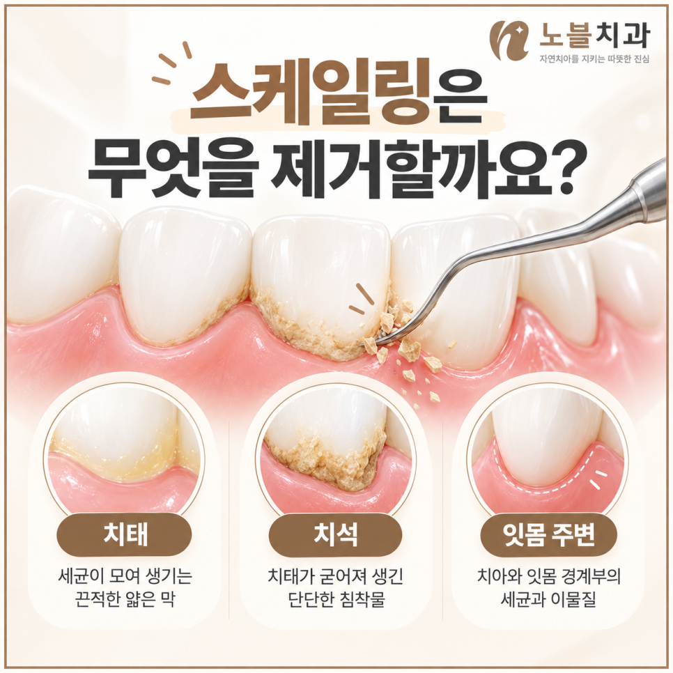 수원치과에서 잇몸이 자꾸 붓고 피가 나면 스케일링만 받아도 될까요?